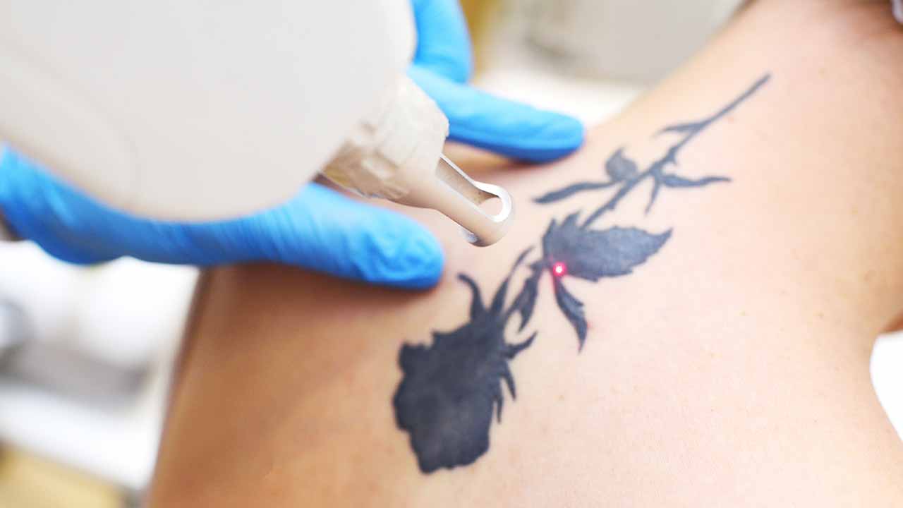 Tattoo Removal
